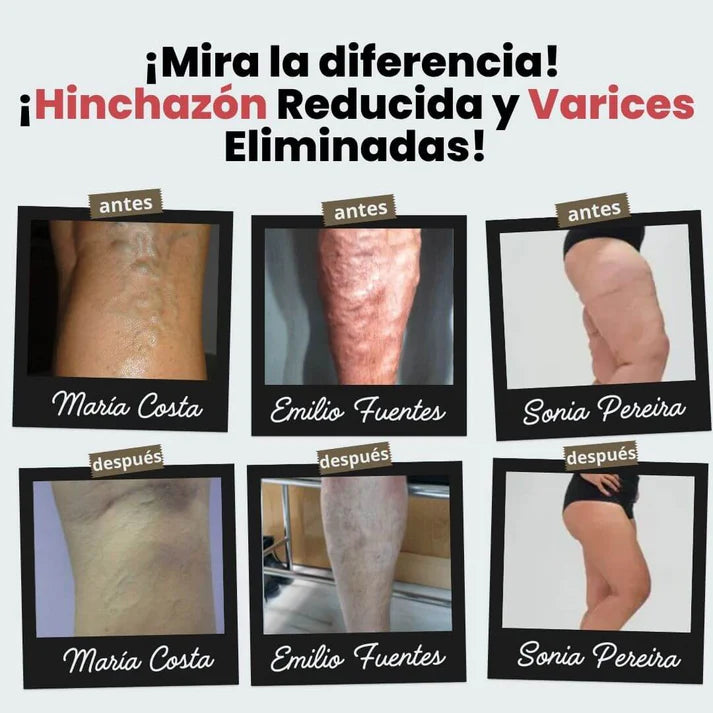 Calcetines de acupresión Anti-Varices | Oferta 2x1